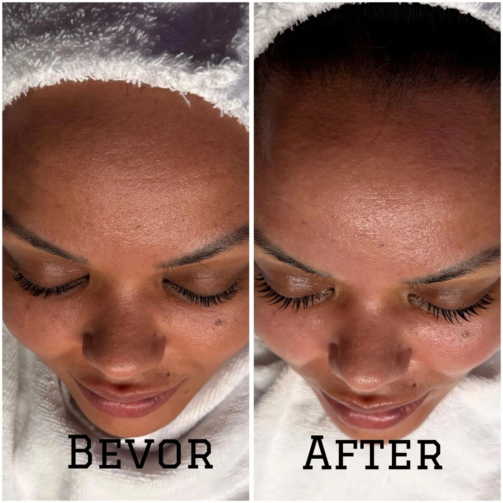 Microneedling Hamburg Vorher Nachher : Ergebnisse gegen Narben & Falten Der Wunsch nach einem ebenmäßigen Teint treibt viele Menschen dazu, nach effektiven Methoden zur Hautverjüngung zu suchen. Wer sich Fotos zum Thema Microneedling Hamburg Vorher Nachher ansieht, ist oft erstaunt über die sichtbaren Verbesserungen bei Narben, Falten und Poren. Doch was steckt wirklich hinter diesem Verfahren und wie läuft es ab? Wir haben die wichtigsten Informationen aus verschiedenen Expertenquellen für Sie zusammengetragen, um Ihnen ein realistisches Bild der Ergebnisse zu vermitteln