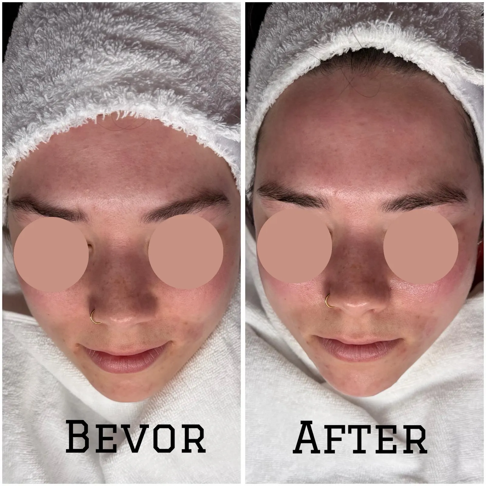 Der Arbeitstag war lang, die Meetings endlos und der Blick auf den Bildschirm hat Spuren hinterlassen. Wenn wir abends in den Spiegel schauen, blickt uns oft nicht das strahlende Ich entgegen, das wir uns wünschen, sondern ein fahler, gräulicher Teint. Augenringe, Trockenheitsfältchen und ein Mangel an Spannkraft sind die typischen Anzeichen von Erschöpfung, die sich direkt auf unser größtes Organ übertragen. Viele Menschen fragen sich in diesem Moment: Müde Haut was tun, um schnell wieder gesellschaftsfähig zu werden? Ob für das Date am Abend, das After-Work-Event oder einfach, um sich wieder wohl in seiner Haut zu fühlen – es gibt Strategien, die den "Glow" zurückbringen.